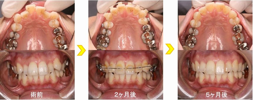 中高生のプチ矯正 ほんの数カ月できれいになります！ - 豊中（千里中央