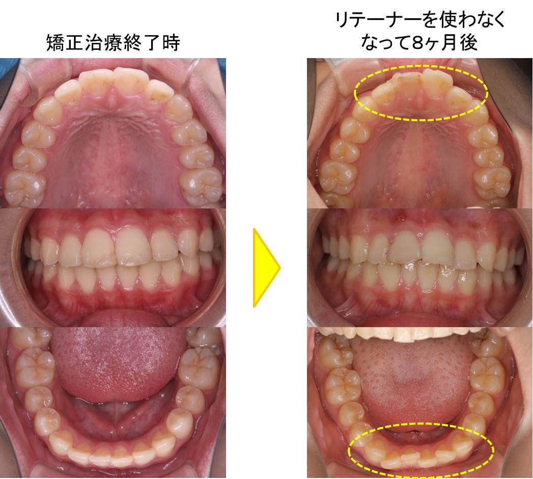矯正治療後の後戻り - 豊中（千里中央）の小児矯正は子供の矯正お悩み