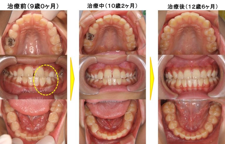 失活歯髄切断法