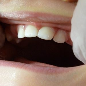 子どもの矯正はいつから始めるべき？
