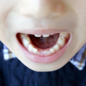 小児矯正の第一期治療で得られるメリットとは？