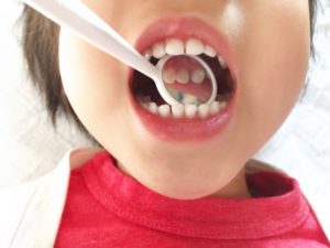乳歯のむし歯が歯並びに与える影響とは？