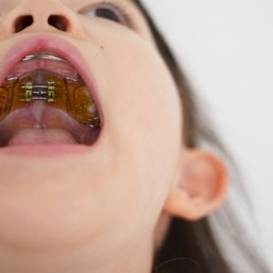 子どもの歯並び、床矯正だけで治せるの？