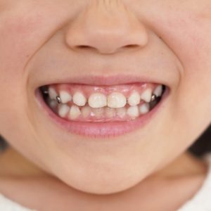 拡大装置を使うと顔が大きくなるって本当でしょうか？