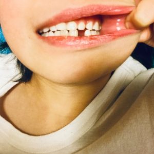 むし歯で乳歯が早く抜けると歯並びが悪くなるの？